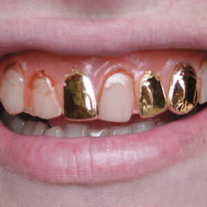 Pirate - Denture Veneer