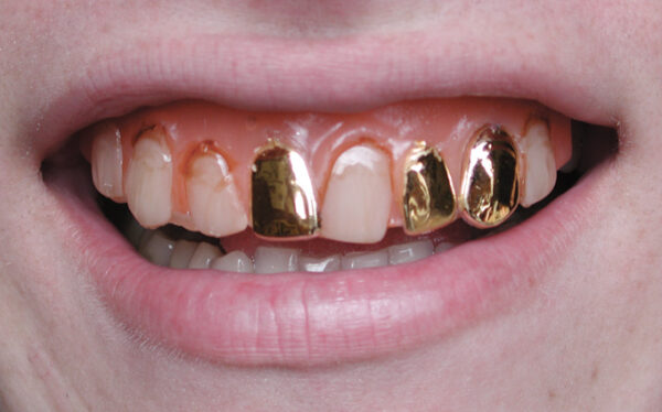 Pirate - Denture Veneer